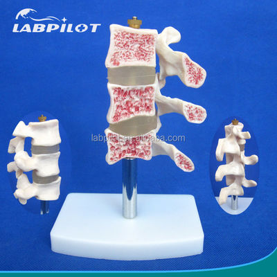 Modelli educativi avanzati di PVC Cutaway Osteoporosi della colonna vertebrale Lesioni della vertebra lombare