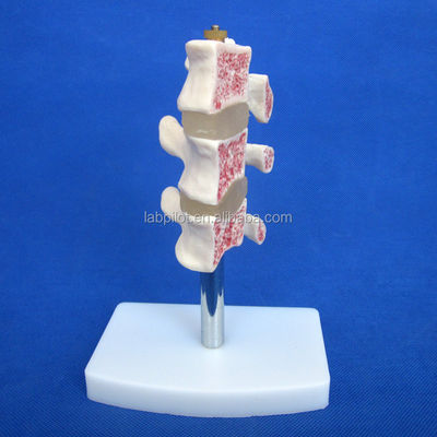Modelli educativi avanzati di PVC Cutaway Osteoporosi della colonna vertebrale Lesioni della vertebra lombare
