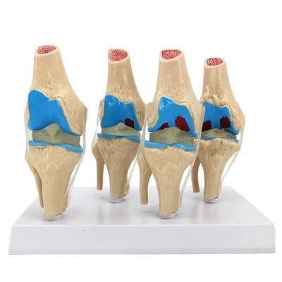 Dimostrazione anatomica del modello di patologia articolare del ginocchio umano per la scienza medica