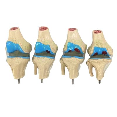 Dimostrazione anatomica del modello di patologia articolare del ginocchio umano per la scienza medica