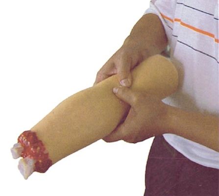 Modello di cura infermieristica traumatologica Amputazione del braccio e emostasi per il trattamento delle ferite degli arti superiori