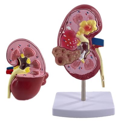 Modello del rene patologico PVC per scuole di medicina e ospedali di urologia