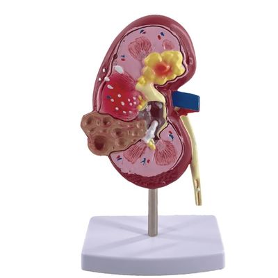 Modello del rene patologico PVC per scuole di medicina e ospedali di urologia